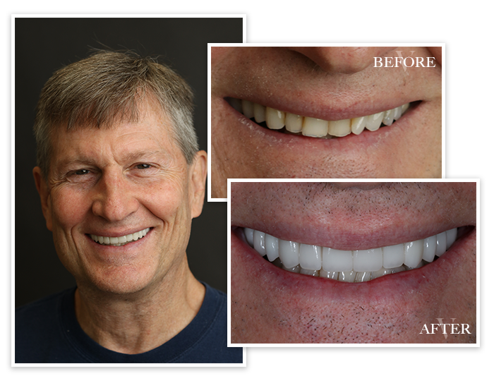 Before and After collage of Patient 2