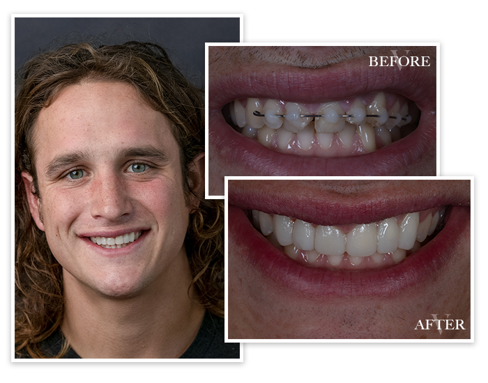 Smile Gallery Collage Patient 5