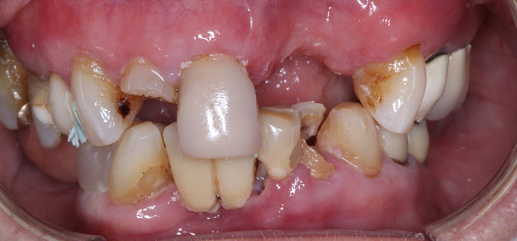 BEFORE