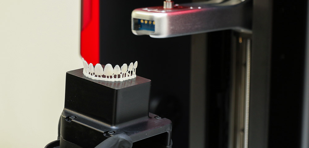 3D-Printed Veneers